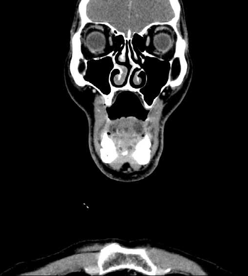 File:Nasopharyngeal carcinoma - infiltrating the clivus (Radiopaedia 62583-70875 D 5).jpg