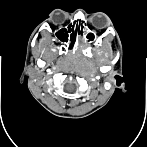 Nasopharyngeal carcinoma with skull base invasion (Radiopaedia 53415-59705 A 36).jpg