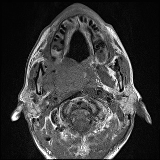Nasopharyngeal carcinoma with skull base invasion (Radiopaedia 59258-66600 B 26).jpg