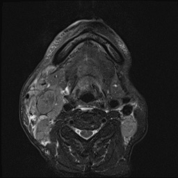 File:Nasopharyngeal carcinoma with skull base invasion (Radiopaedia 59258-66600 D 45).jpg