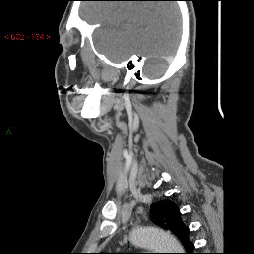 File:Nasopharyngeal lymphoma (Radiopaedia 54235-60433 B 41).jpg