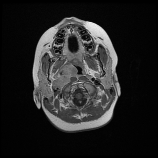 File:Nasopharyngeal rhabdomyosarcoma (Radiopaedia 23417-23486 Axial T1 C+ 1).jpg