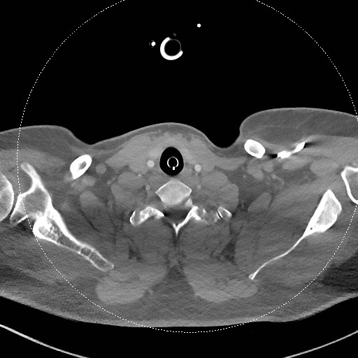 File:Neck CT angiogram (intraosseous vascular access) (Radiopaedia 55481-61945 B 122).jpg