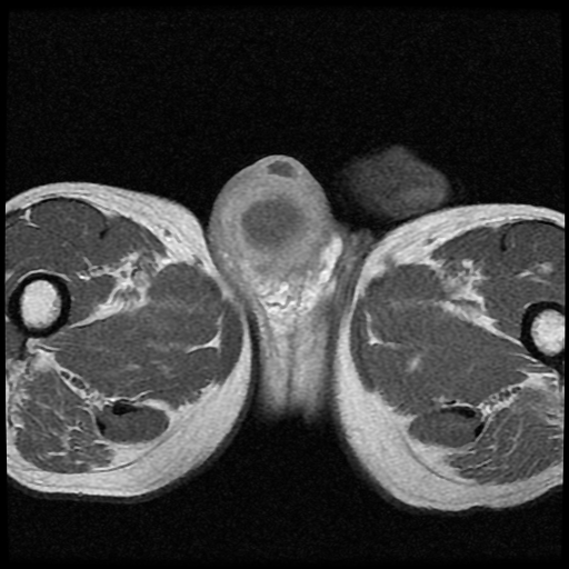 File:Necrotizing epididymo-orchitis with intra-testicular abscess (Radiopaedia 29397-29860 Axial T1 C+ 13).jpg