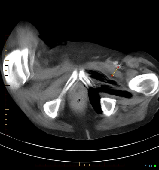 Necrotzing fasciitis due to a perforated adenocarcinoma of the splenic flexure (Radiopaedia 46930-51455 A 66).jpg