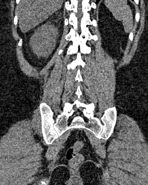 File:Nephrostomy for urosepsis (Radiopaedia 26180-26330 non-contrast 70).jpg