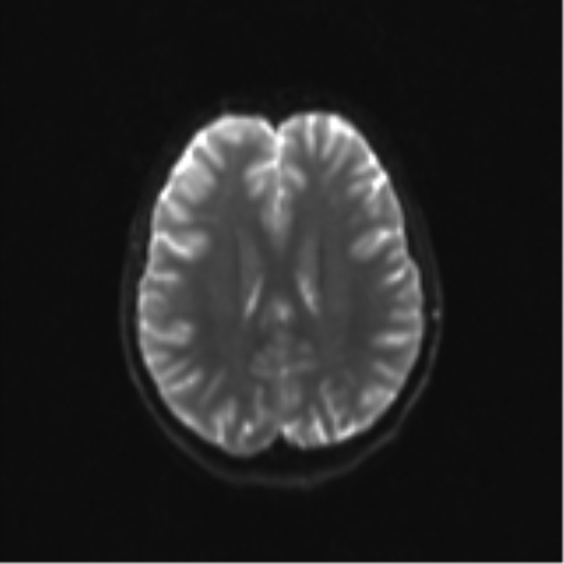 Neurenteric cyst (Radiopaedia 58641-65837 Axial DWI 24).png