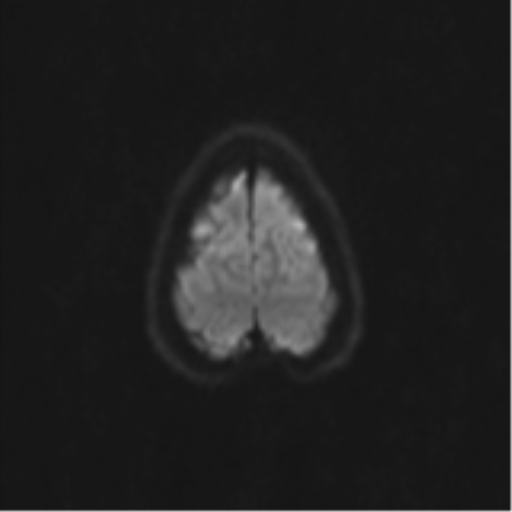 Neurenteric cyst (Radiopaedia 58641-65837 Axial DWI 66).png