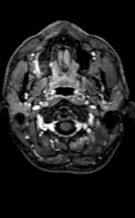 Neuro-Behçet disease (Radiopaedia 90112-107294 Axial T1 C+ 203).jpg
