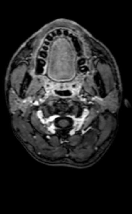 Neuro-Behçet disease (Radiopaedia 90112-107294 Axial T1 C+ 216).jpg