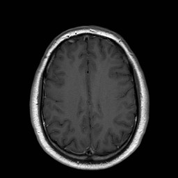 File:Neuro-Behcet's disease (Radiopaedia 21557-21505 Axial T1 C+ 16).jpg