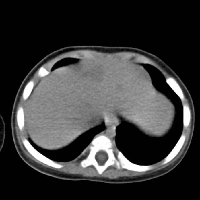 Neuroblastoma with skull metastases (Radiopaedia 30326-30960 Axial non-contrast 5).jpg