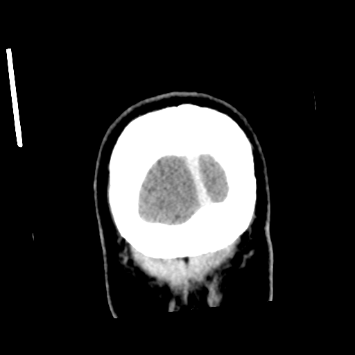 Neurocysticercosis - granular nodular (Radiopaedia 42786-45957 Coronal C+ 63).png