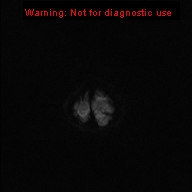 File:Neurofibromatosis type 1 with optic nerve glioma (Radiopaedia 16288-15965 Axial DWI 49).jpg