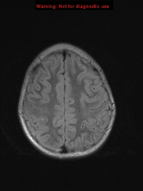 File:Neurofibromatosis type 1 with optic nerve glioma (Radiopaedia 16288-15965 Axial FLAIR 6).jpg