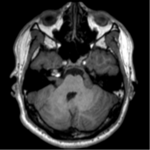 File:Neurofibromatosis type 2 (Radiopaedia 44936-48838 Axial T1 32).png