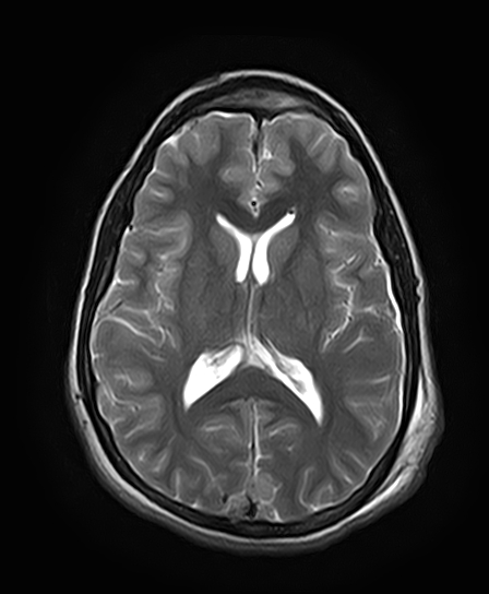 File:Neurofibromatosis type 2 (Radiopaedia 66211-75401 Axial T2 18).jpg