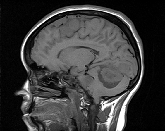 File:Neurofibromatosis type 2 (Radiopaedia 66211-75401 Sagittal T1 11).jpg