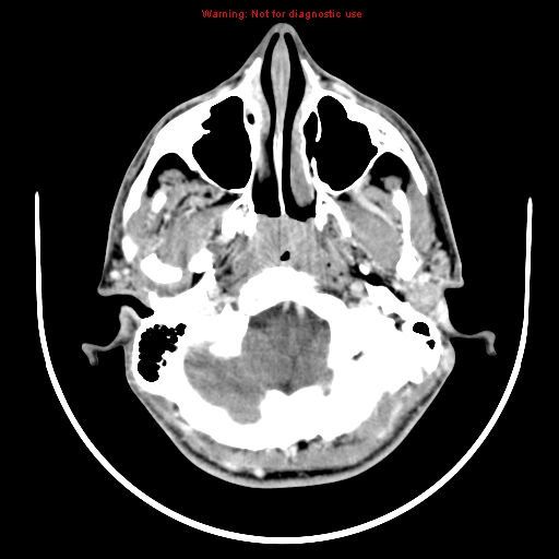 File:Neurofibromatosis type 2 (Radiopaedia 8953-9732 C 1).jpg
