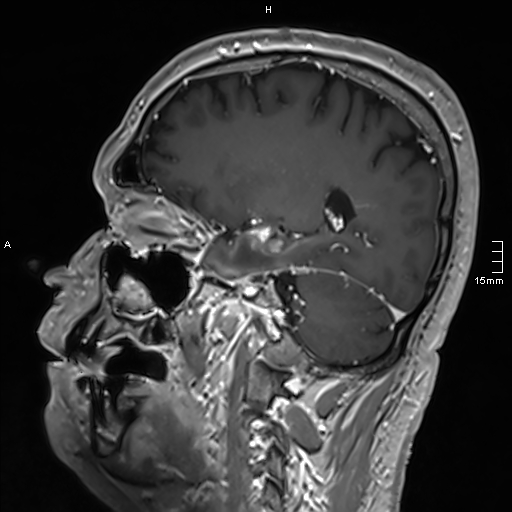 Neurosarcoidosis - involvement of the mesial temporal lobes (Radiopaedia 67429-76820 Sagittal T1 C+ 63).jpg