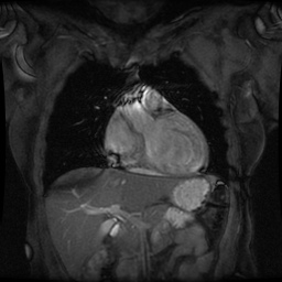 File:Non-compaction of the left ventricle (Radiopaedia 38868-41062 Coronal SSFP 2D FS 9).jpg