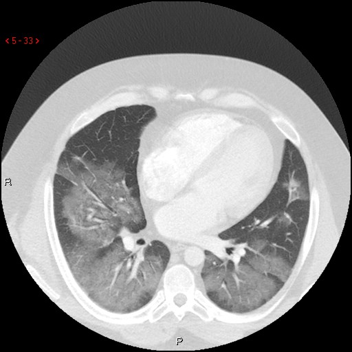 File:Non-specific interstitial pneumonitis (Radiopaedia 27044-27222 Axial lung window 24).jpg