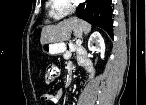 Non-syndromic pancreatic endocrine tumor (Radiopaedia 86958-103178 E 42).jpg
