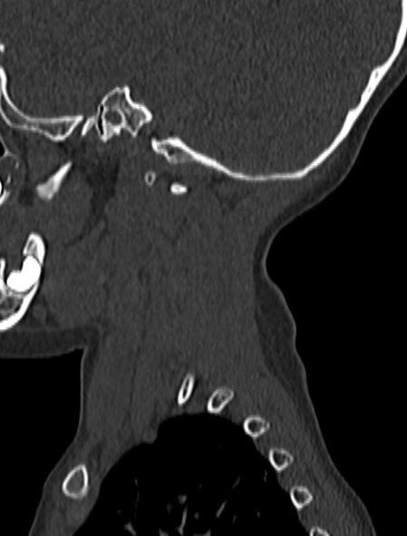 Normal CT cervical spine - pediatric (Radiopaedia 52549-58462 Sagittal bone window 206).jpg