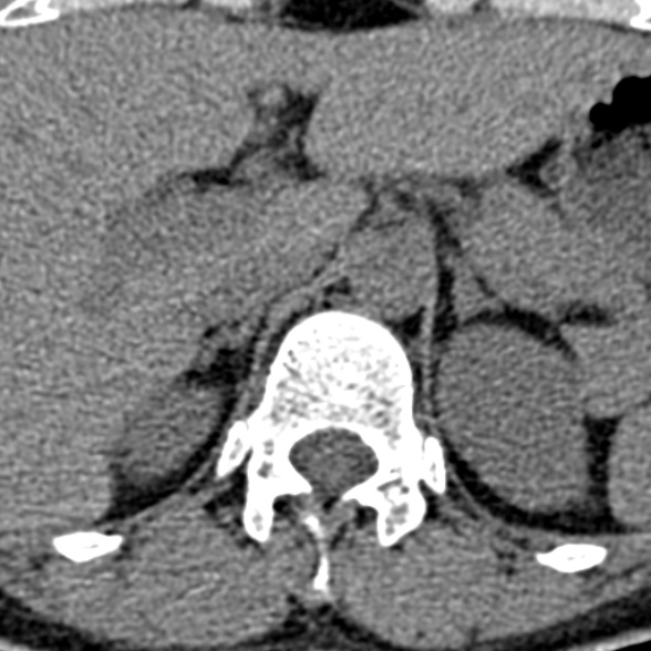 Normal CT lumbar spine (Radiopaedia 53981-60118 Axial non-contrast 2).jpg