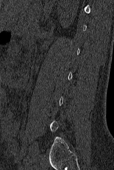 File:Normal CT lumbar spine (Radiopaedia 53981-60118 Sagittal bone window 75).jpg