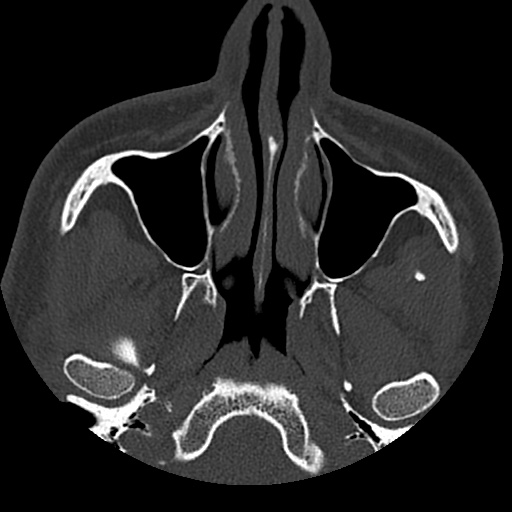 Normal CT paranasal sinuses (Radiopaedia 42286-45390 Axial bone window 79).jpg