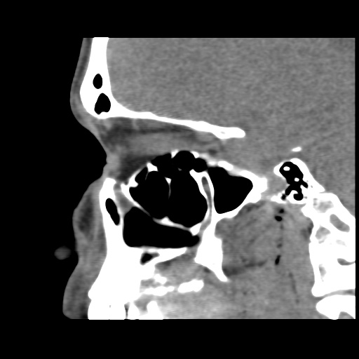 Normal CT paranasal sinuses (Radiopaedia 42286-45390 F 61).jpg