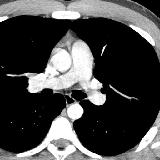 File:Normal CT pulmonary veins (pre RF ablation) (Radiopaedia 41748-44702 A 82).png