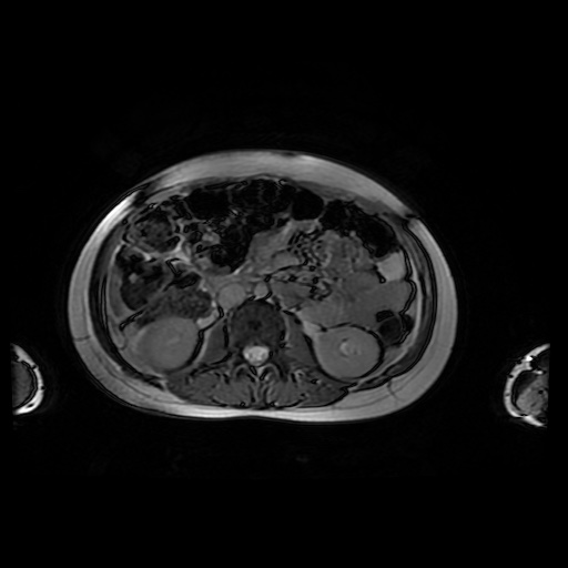 File:Normal MRI abdomen in pregnancy (Radiopaedia 88001-104541 Axial Gradient Echo 24).jpg