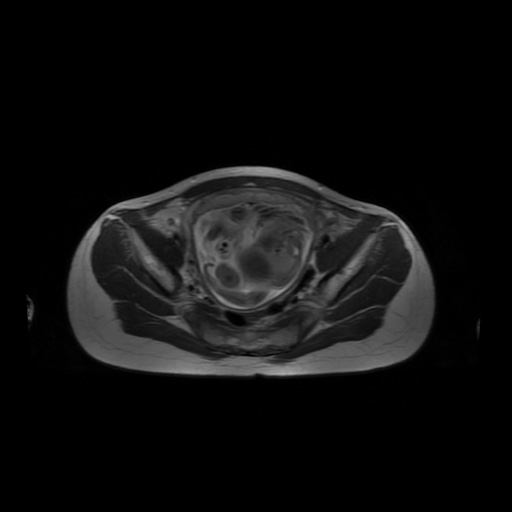 File:Normal MRI abdomen in pregnancy (Radiopaedia 88001-104541 Axial T2 57).jpg