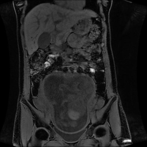 Normal MRI abdomen in pregnancy (Radiopaedia 88001-104541 M 60).jpg