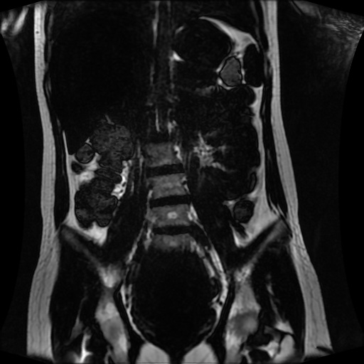 Normal MRI abdomen in pregnancy (Radiopaedia 88001-104541 N 80).jpg