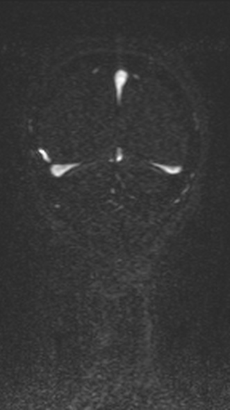 Normal MRI brain with MRV- teenager (Radiopaedia 49425-54553 Coronal MRV 206).jpg