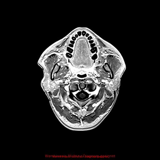 Normal adult brain MRI (non-enhanced and contrast-enhanced) (Radiopaedia 75262-86379 Axial T1 C+ 26).jpg