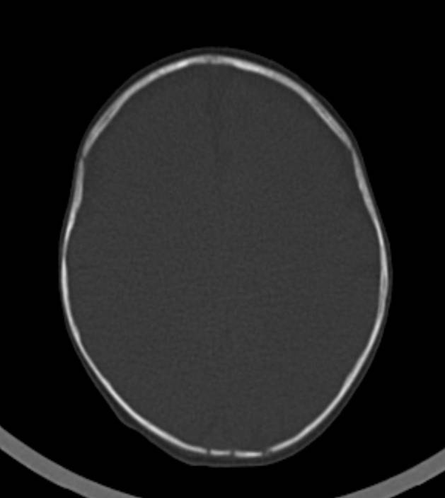 Normal brain CT - 2-month-old (Radiopaedia 53369-59350 Axial bone window 21).jpg