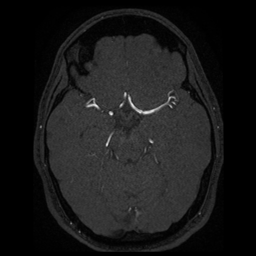 Normal brain MRA (Radiopaedia 41046-43793 Axial MRA 52).png