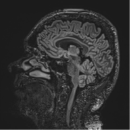 Normal brain MRI (non-focal epilepsy protocol) (Radiopaedia 53917-60040 Sagittal DIR 35).png