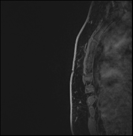 Normal breast MRI - dense breasts (Radiopaedia 80454-93850 I 179).jpg