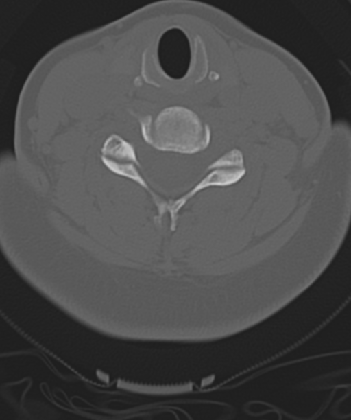 Normal cervical spine MRI (including Dixon) (Radiopaedia 42762-45926 Axial bone window 36).png