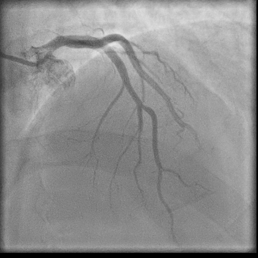 Normal coronary angiogram (DSA) (Radiopaedia 63081-71571 E 28).jpg
