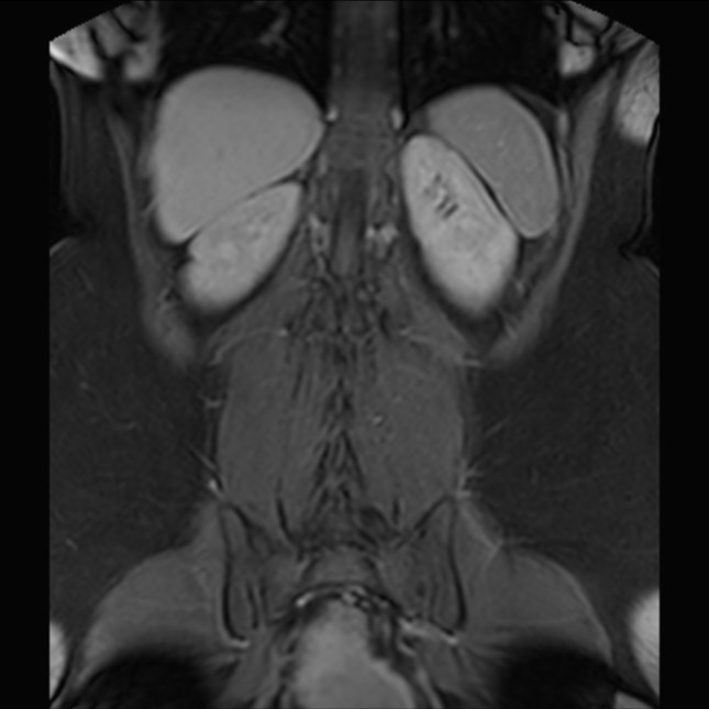 Normal liver MRI with Gadolinium (Radiopaedia 58913-66163 P 67).jpg