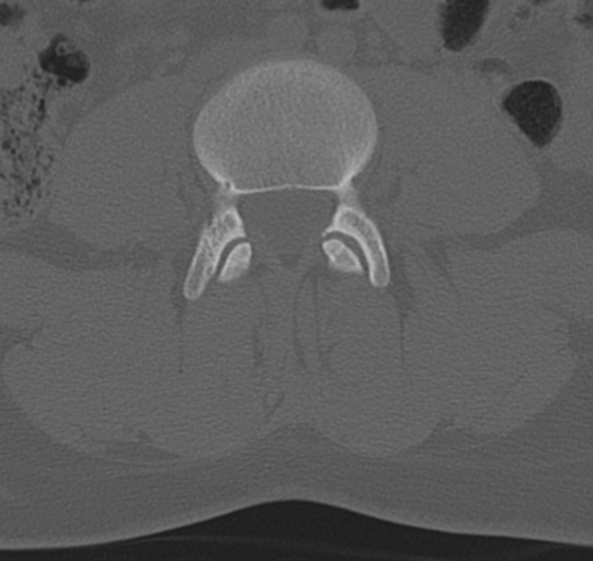 File:Normal lumbar spine CT (Radiopaedia 46533-50986 Axial bone window 44).png
