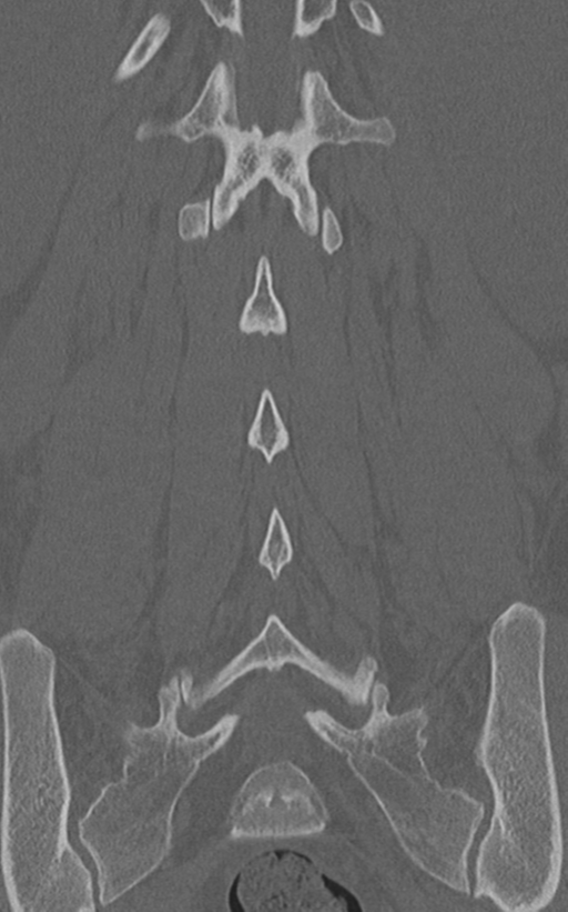 Normal lumbar spine CT (Radiopaedia 46533-50986 Coronal bone window 54).png