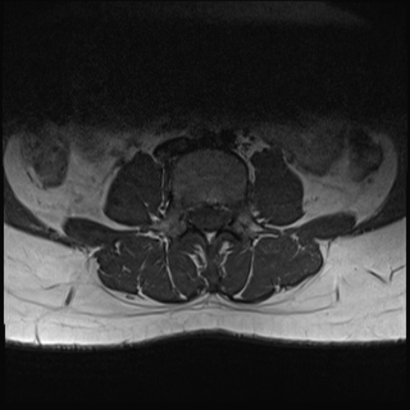 File:Normal lumbar spine MRI- 3 T (Radiopaedia 53280-59250 Axial 13).jpg