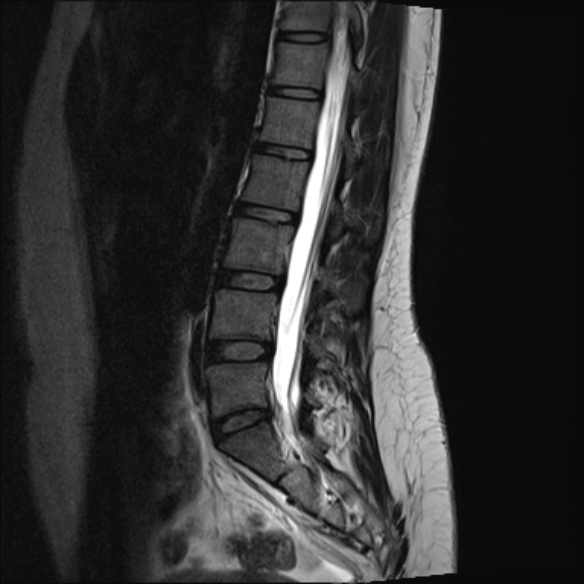 File:Normal lumbar spine MRI- 3 T (Radiopaedia 53280-59250 Sagittal T2 15).jpg